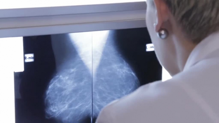 Breast Unit cancer.mp4